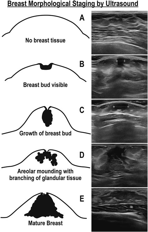 teenage huge boobs|Breast development: Stages and how to spot growth signs .